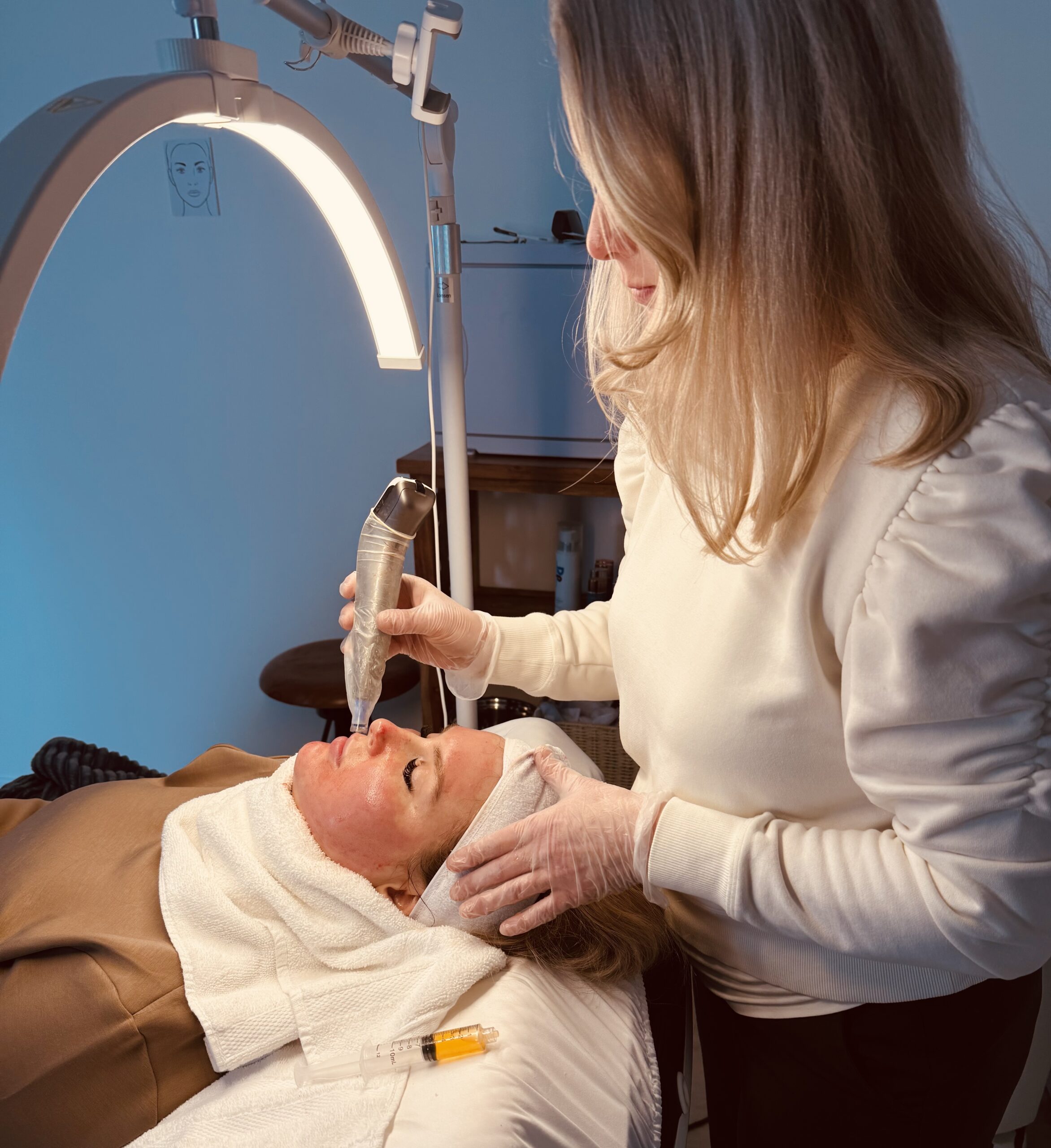 Microneedling with PRP